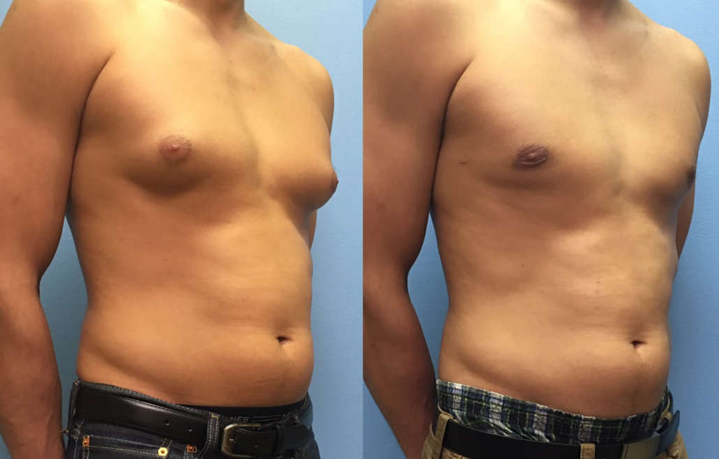 Male Breast Surgery In Pune Gynaecomastia Surgery Dr Shilpy Dolas