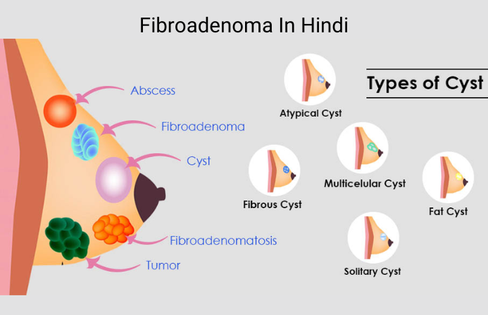 Fibroadenoma In Hindi