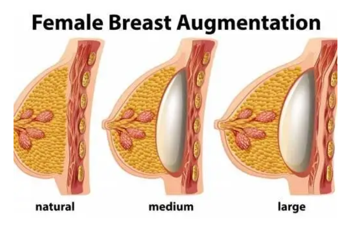 Breast Enlargement Treatment