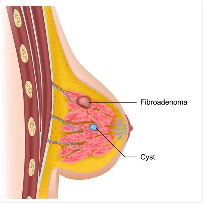 Fibroadenoma